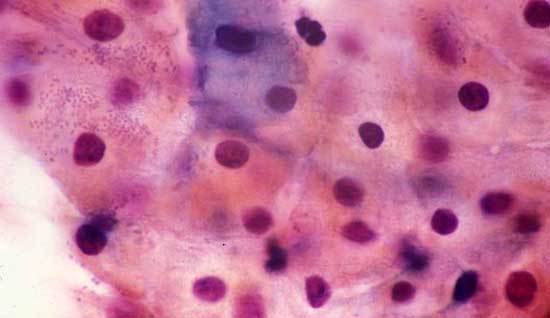 cellule epiteliali squamose atipiche
