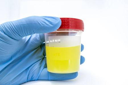 cellule epiteliali squamose nelle urine